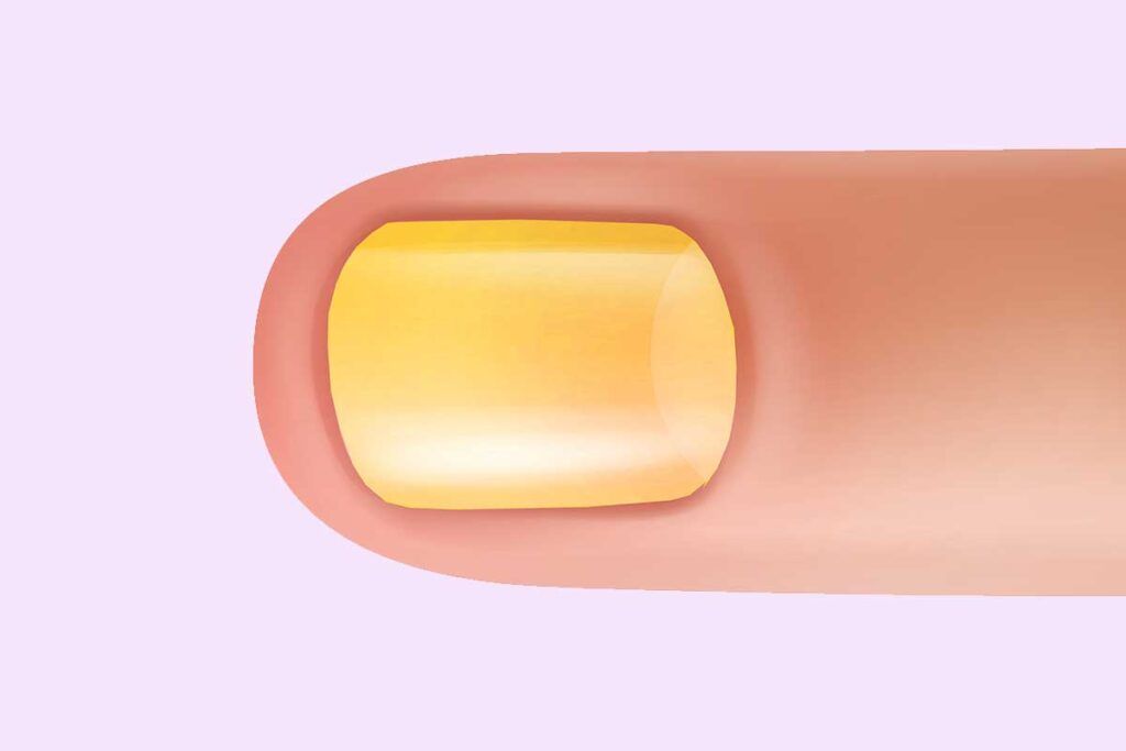 Síndrome de las uñas amarillas: identificada la causa génica