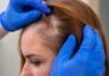 Alopecia femenina: una conexión entre genes aumenta su riesgo Alopecia femenina: una conexión entre genes aumenta su riesgo