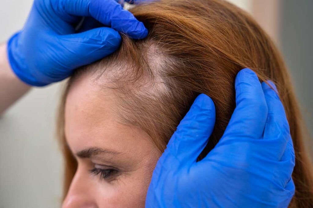 Alopecia femenina: una conexión entre genes aumenta su riesgo