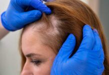 Alopecia femenina: una conexión entre genes aumenta su riesgo Alopecia femenina: una conexión entre genes aumenta su riesgo