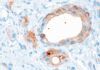 Innovador análisis para pronóstico de cáncer de próstata avanzado Innovador análisis para pronóstico de cáncer de próstata avanzado