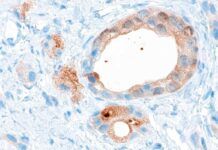 Innovador análisis para pronóstico de cáncer de próstata avanzado Innovador análisis para pronóstico de cáncer de próstata avanzado
