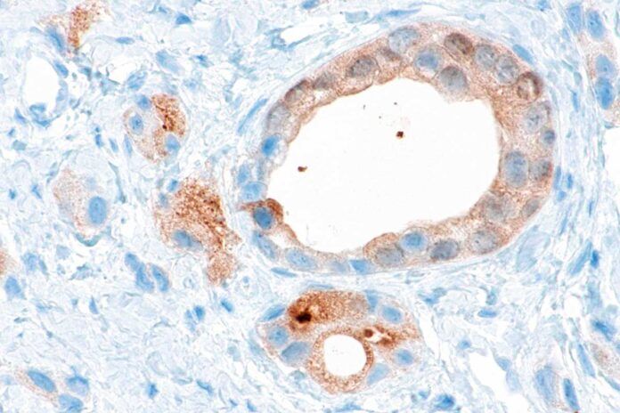Innovador análisis para pronóstico de cáncer de próstata avanzado