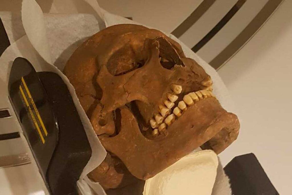 Los vikingos padecían graves enfermedades maxilofaciales