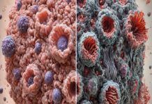 Avances en el tratamiento del cáncer colorrectal Avances en el tratamiento del cáncer colorrectal