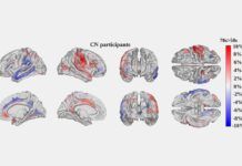 Miden cómo envejece el cerebro con IA Miden cómo envejece el cerebro con IA