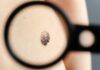 Melanoma: ¿Cómo se produce la metástasis ósea? Melanoma: ¿Cómo se produce la metástasis ósea?