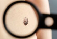 Melanoma: ¿Cómo se produce la metástasis ósea? Melanoma: ¿Cómo se produce la metástasis ósea?