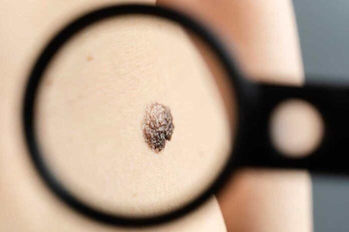 lunar Melanoma: ¿Cómo se produce la metástasis ósea?