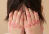 Hacia un nuevo tratamiento terapéutico para la psoriasis Hacia un nuevo tratamiento terapéutico para la psoriasis