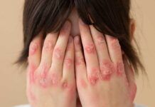 Hacia un nuevo tratamiento terapéutico para la psoriasis Hacia un nuevo tratamiento terapéutico para la psoriasis