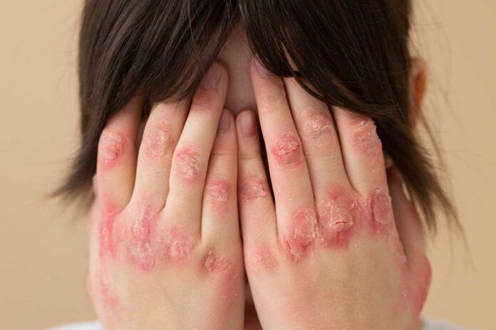 psoriasis Hacia un nuevo tratamiento terapéutico para la psoriasis