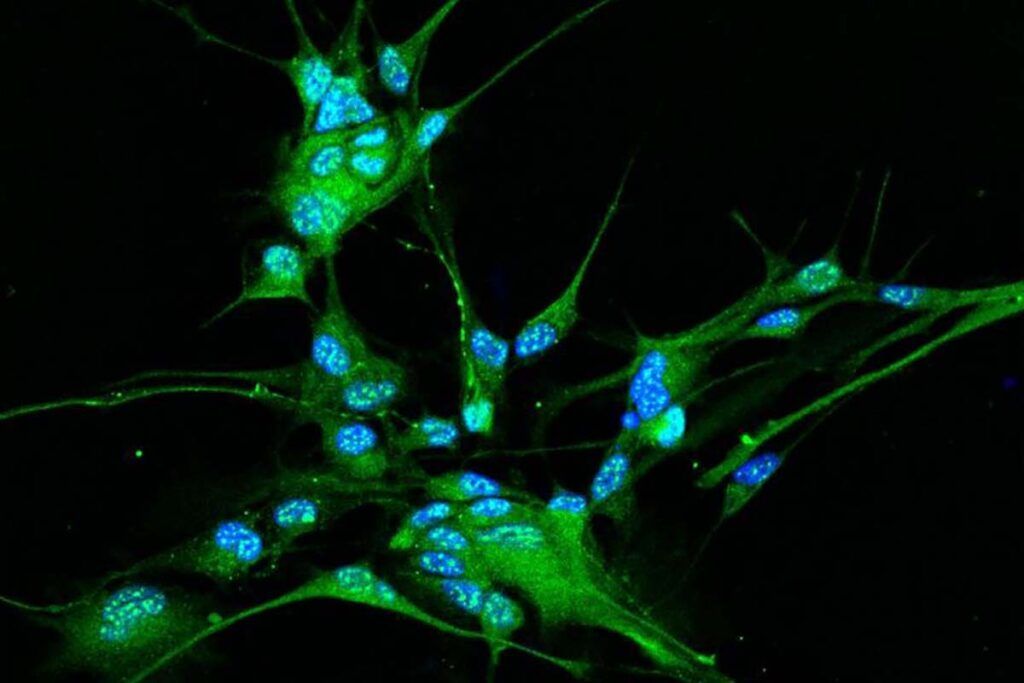 Visualizan cómo se multiplican las células cancerosas en el glioblastoma