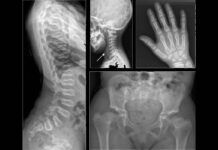 Desvelado el misterio de una rara enfermedad ósea Desvelado el misterio de una rara enfermedad ósea