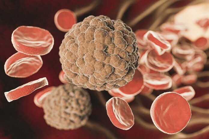 sepsis Nuevo diagnóstico rápido de sepsis