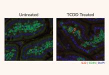 ¿Por qué fumar favorece la aparición de cáncer de páncreas? Fumar favorece la aparición de cáncer de páncreas