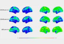 Síndrome de Down: alta prevalencia de Alzheimer en adultos Síndrome de Down: alta prevalencia de Alzheimer en adultos mayores