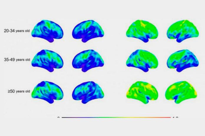 Síndrome de Down: alta prevalencia de Alzheimer en adultos mayores
