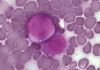 ¿Cómo la leucemia engaña al sistema inmunitario? ¿Cómo la leucemia engaña al sistema inmunitario?