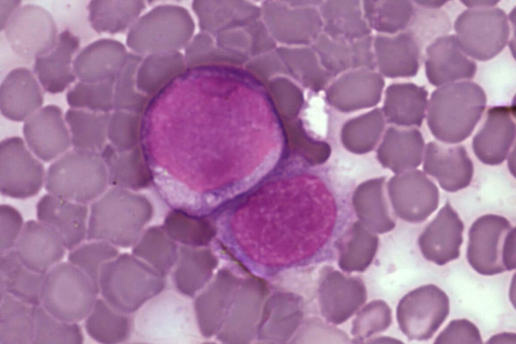 ¿Cómo la leucemia engaña al sistema inmunitario?