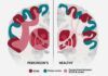 Identifican la base neurológica del mal de Parkinson Identifican la base neurológica del mal de Parkinson