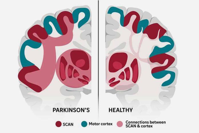 Identifican la base neurológica del mal de Parkinson