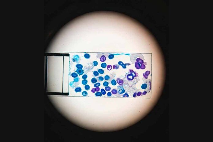 leucemia Descubren cómo la leucemia engaña al sistema inmunitario