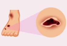 Innovador gel para heridas que no cicatrizan Innovador gel para heridas que no cicatrizan