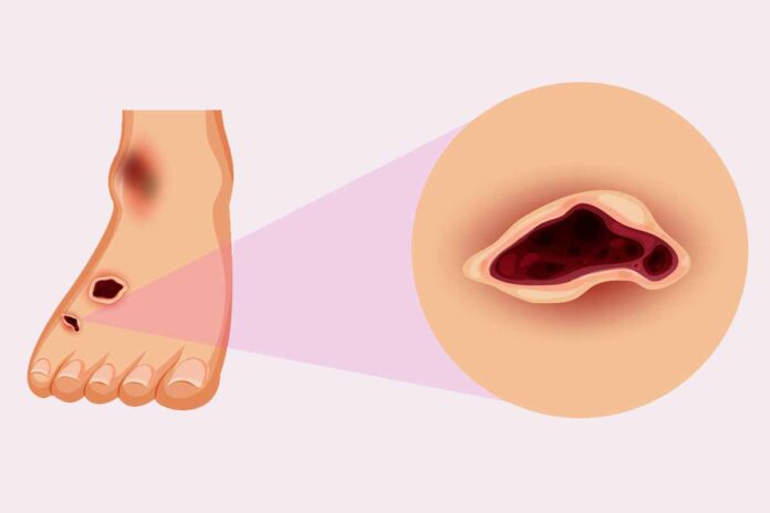 Innovador gel para heridas que no cicatrizan