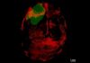 El glioblastoma también devora el cráneo El glioblastoma también devora el cráneo