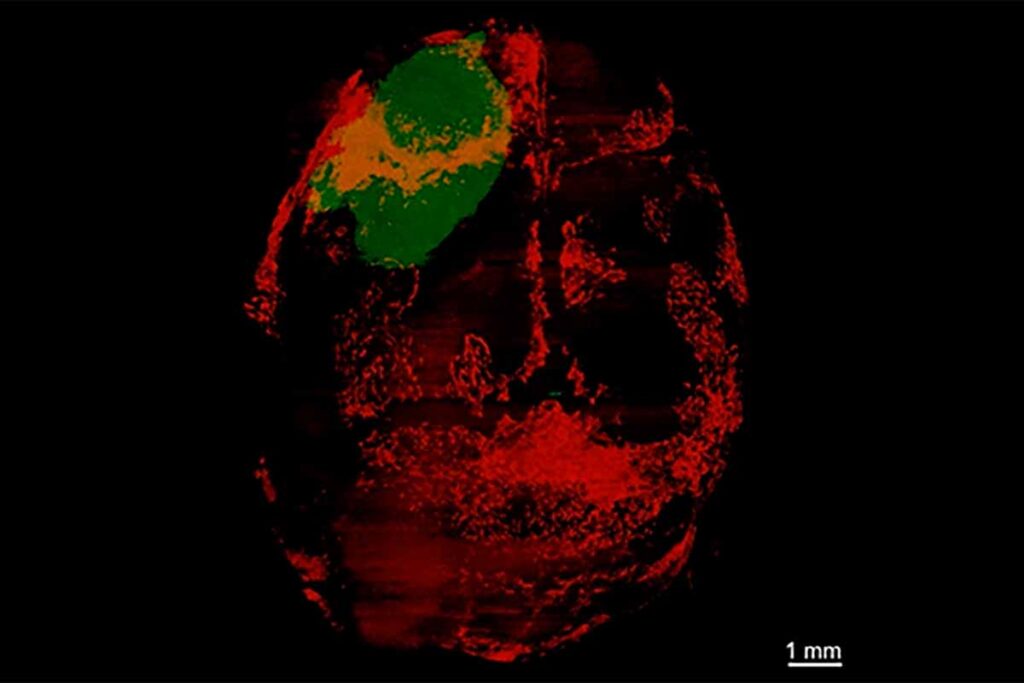 El glioblastoma también devora el cráneo