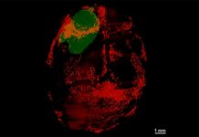 El glioblastoma también devora el cráneo El glioblastoma también devora el cráneo