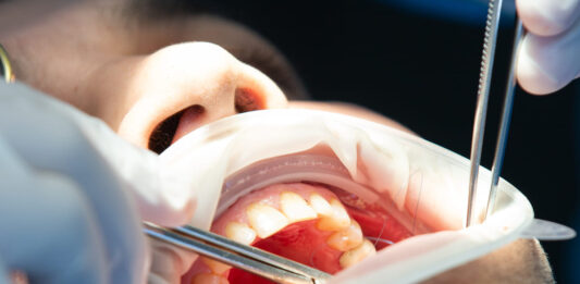 Eliminan con ultrasonidos células cancerosas de la boca Eliminan con ultrasonidos células cancerosas de la boca