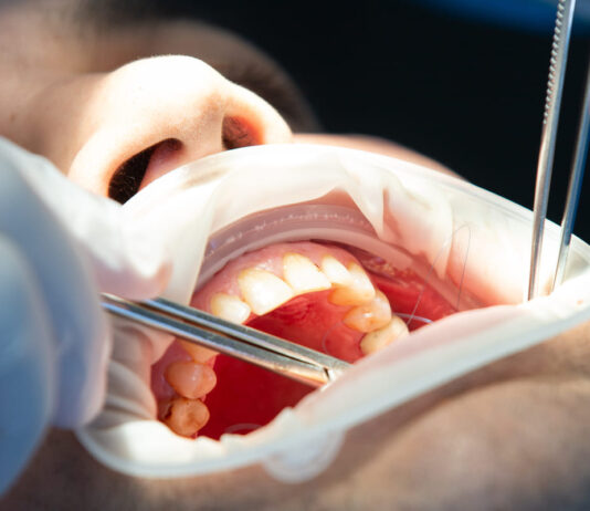 Eliminan con ultrasonidos células cancerosas de la boca Eliminan con ultrasonidos células cancerosas de la boca